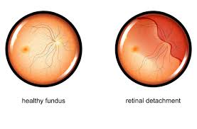 Image result for Retinal Detachment