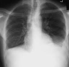 Direct management of pleural effusions due to heart failure may be hampered by the presence of bilateral effusions. Chest Radiograph Demonstrating Small Bilateral Pleural Effusions Download Scientific Diagram