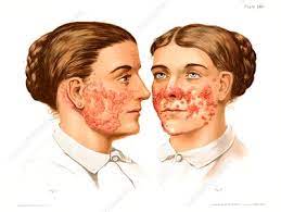 * forma luposa = granuloma es completo. Lupus Erythematosus And Vulgaris Illustration Stock Image C030 8488 Science Photo Library