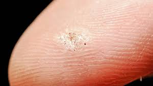 They are caused by the human papillomavirus and are usually painless. Seed Warts Contagious On Fingers Home Remedies On Foot