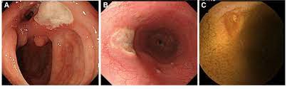 Large ulcers (red, black and white arrows) are seen in these two views of the distal esophagus from. Gastrointestinal Lesions In Bd A A Typical Giant Oval Shaped Deep Download Scientific Diagram
