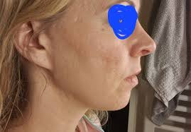 Fibrose nach Facelift