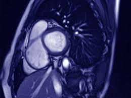 Management, and therapy of myocarditis: Kardio Mrt Kardiocentrum Frankfurt