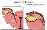 Resultado de imagen para "sangrado rectal" sangre color rosa