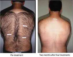 The gentlemax pro, gentlelase or gentleyag laser emits a beam of light energy that passes through the skin to the hair follicle where it is absorbed. Hair Removal Important Information Body Beautiful Laser Medi Spa