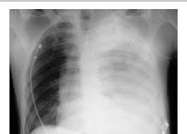Image result for Hemothorax