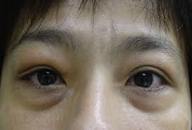 Image result for Dacryoadenitis