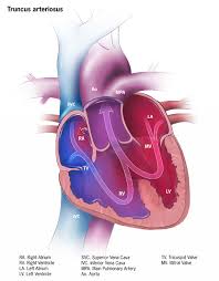 Truncus Arteriosus Concise Medical Knowledge