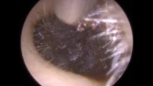 Dark Brown Ear Wax Removed From Ear Canal Mr Neel Raithatha The Hear Clinic