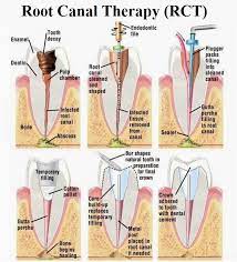 Periodonticsplantation Implantsplantation Laserplantation Periodontistplantation Http Www Andregrenierdmd Com Dental Hygiene School Dental Dentistry