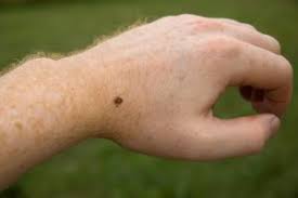 Fibromyalgia Vs Lyme Disease Differences In Symptoms Causes And Treatment Options