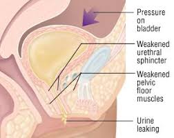 Urinary Incontinence Health Topics Urinary Incontinence Stress Incontinence Incontinence
