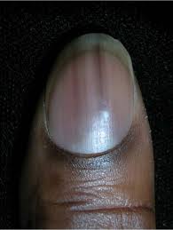 Irregular edges, is not painful. Dark Lines On Nails Mdedge Family Medicine