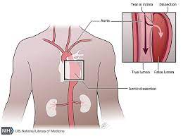 Marfan Syndrome: Medlineplus Genetics