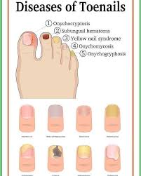 Image result for Yellow nail syndrome feet
