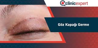 Goz Kapagi Germe Clinicexpert Estetik Merkezi