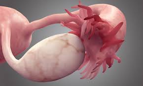 Ovarian cancer refers to malignant tumors originating in the ovaries, which can spread ovarian cancer is the 5th leading cause of death in women. Losartan Could Improve Ovarian Cancer Treatment Epr