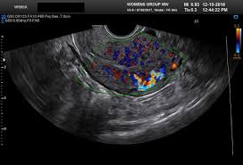 While some spotting is harmless, it can also mean something more serious. Diagnostic Ultrasound In The First Trimester Of Pregnancy Glowm