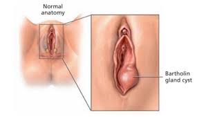 Image result for Bartholin's gland abscess