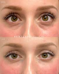 🪄👀 Softening her under-eyes using 💉2 syringes of Restylane in the tear  trough area. 🥼Unmatched precision, safety, and expert technique.  🖊️Marking the orbital rim and infraorbital foramen BEFORE using a  cannula—ensuring the