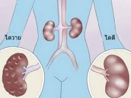 ไตวายเรื้อรัง (chronic kidney failure หรือ chronic renal failure) อาการของไตวายเรื้อรังจะไม่เกิดขึ้น à¸ à¸²à¸§à¸°à¹„à¸•à¸§à¸²à¸¢à¹€à¸‰ à¸¢à¸šà¸žà¸¥ à¸™