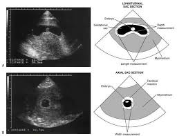 Mean Sac Diameter Msd Three Measurements Of The Gestational Sac Length Depth And Width Are Obtained Sum Gestational Age Medical Ultrasound Ultrasound