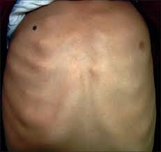 Ribeiro r.c., saltz r., mangles m.g., koch h., et al. Indian Journal Of Dermatology Venereology And Leprology Poland Sq S Syndrome