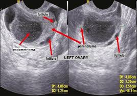 It manifests in three ways; Scielo Brasil Transvaginal Ultrasound In Deep Endometriosis Pictorial Essay Transvaginal Ultrasound In Deep Endometriosis Pictorial Essay