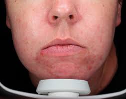 HOW I DO IT Approaches to acne treatment: Pulsed-dye laser