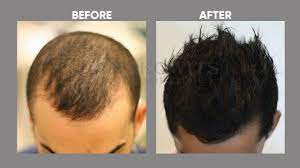It is safe and minimally invasive. Benefits Of Prp Treatment For Hair Loss Hair Transplantation Berkowits