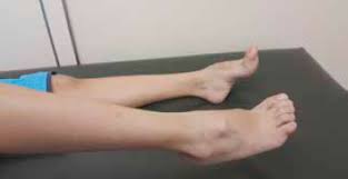Charcot Marie Tooth Disease Sciencedirect
