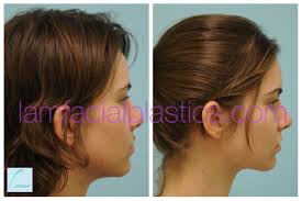This Young Lady Had A Mole Removed From Her Upper Lip And Is Shown Before And Six Months After Her Procedure Moleremova Mole Removal Facial Plastic Upper Lip