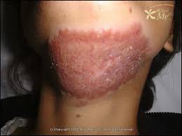What happens during a tuberculosis skin test and what do the results mean? Tuberculosis Of Skin