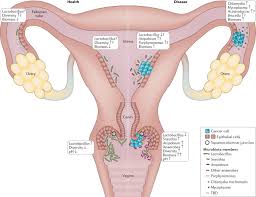 Now she is on a mission to encourage women to look out for the signs and symptoms of ovarian. The Microbiome And Gynaecological Cancer Development Prevention And Therapy Nature Reviews Urology