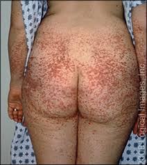 The term purpura is usually used to refer to a skin rash in which small spots of blood appear on the skin. Henoch Schonlein Purpura American Family Physician