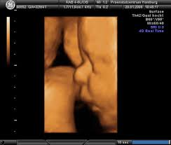 Our baby boy nicolai in 4d ultrasonic. 3d 4d Ultraschall Pranatalzentrum Hamburg Und Humangenetik Im Gynaekologicum