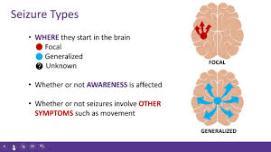 A seizure occurs when the brain. Preparing For And Recovery After Your Child S Epilepsy Surgery Epilepsy Foundation