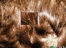 What Does Lice Nits Look Like In Lice Nits Louse Lice Removal