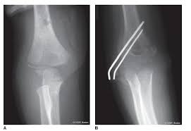 Image result for Lateral Condyle Fracture