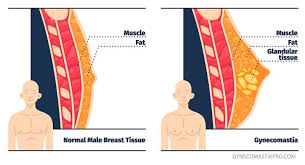 Unul dintre cei mai buni medici chirurgi esteticieni din romania, vitalie stan, in actiune la o operatie de gigantomastie. Ginecomastie Operatie Pt Sani La Barbati Dr Juravle
