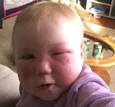 Sunscreen and kids go together in the summer, but they don't always get along. Baby Suffers Chemical Burns From Reaction To Sunscreen