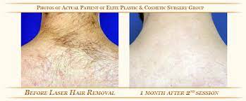 In electrolysis, each individual hair has to be targeted one at a time. Laser Hair Removal Treatment Dubai Uae Best Plastic Cosmetic Surgery Clinic Dubai Uae