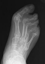 Image result for XRay Changes in Rheumatic Conditions