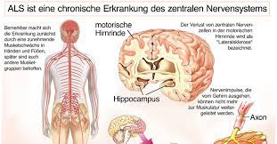 What is amyotrophic lateral sclerosis (als)? Als Amyothrophe Lateralsklerose Journalmed De