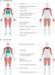 Image result for Myopathy