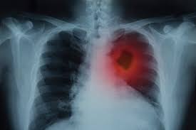 Image result for lung cancer xray
