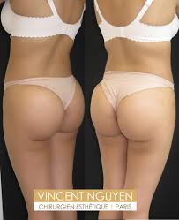 3d adipofilling® subcutaneous volumetric and intradermal regenerative adipofilling. Lipofilling Fessier Ou Des Fesses Lifting Bresilien Paris