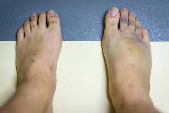 Chân bị bầm tím phải làm sao, hướng dẫn xử lý đúng cách - Long huyết P/H -  Tan bầm tím, giảm phù nề, mau lành vết thương
