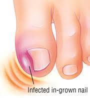 Often you can take care of ingrown toenails on your own. How To Treat A Swollen Toe With Pus Quora