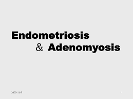 Adenomyosis is a benign disorder of the uterus where the endometrial tissue of the endometrial cavity in the uterus grows into the uterine muscle, damaging the. Ppt Endometriosis Adenomyosis Powerpoint Presentation Free Download Id 302489